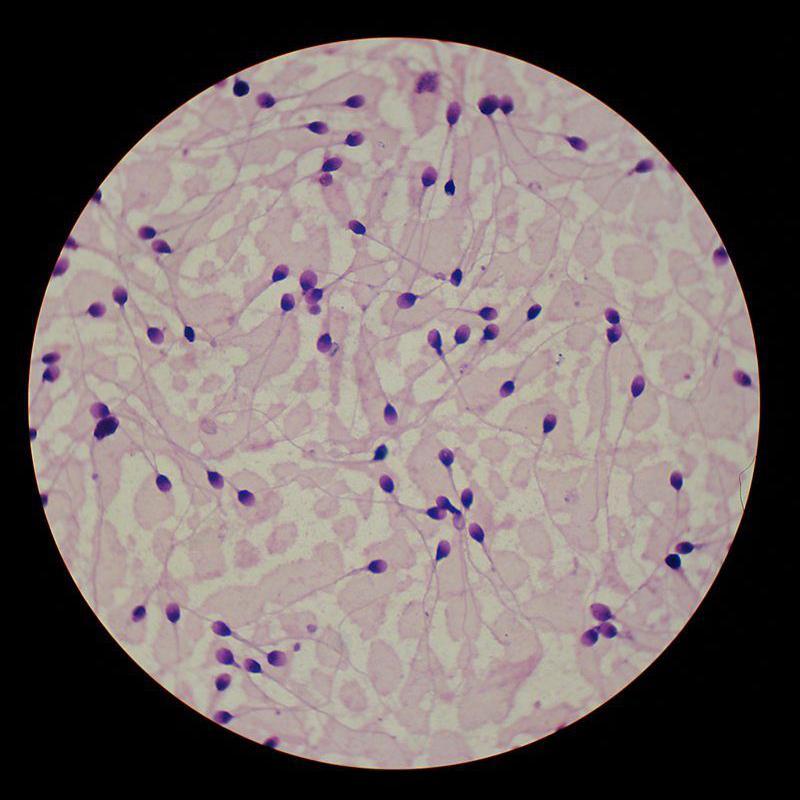 Amostra de sêmen colorida ao microscópio, com os espermatozoides tingidos de roxo