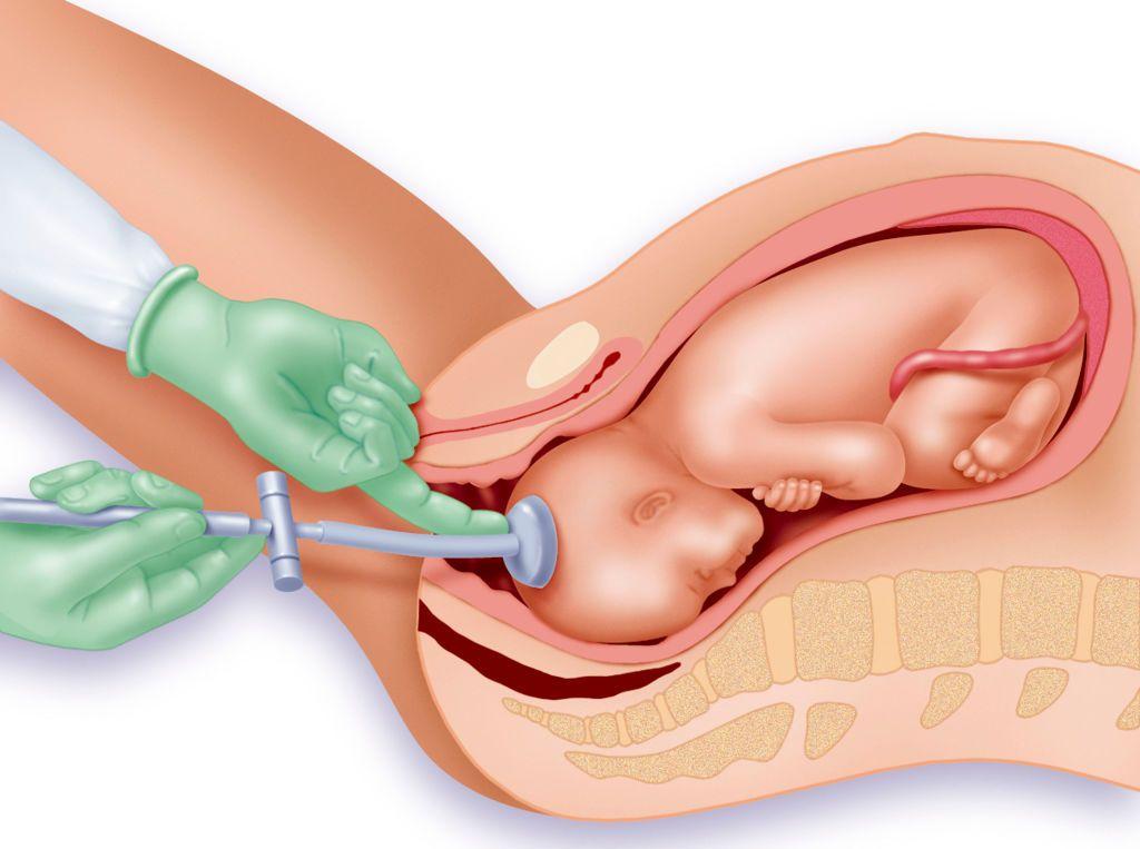 Ilustración de la venosa obstétrica, en la se ve como una copa de succión se pega a un bebé mientra para ayudarlo a salir por la vagina.