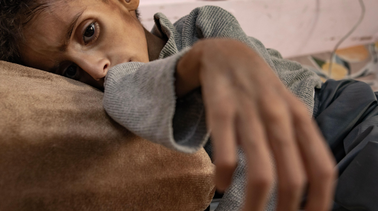 طفل في غزة يعاني من سوء التغذية