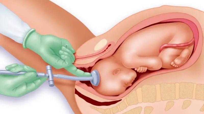 A diagram shows a baby being born with a suction device attached to its head. A pair of hands in green gloves helps assist the delivery