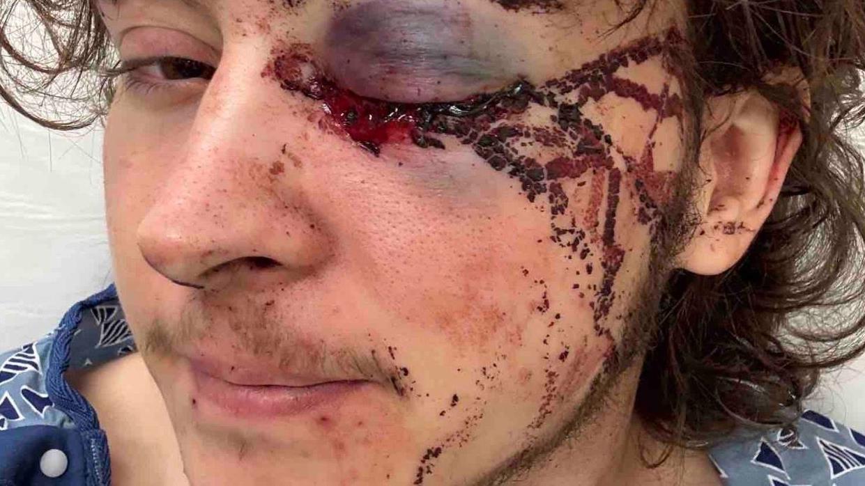 Primer plano de Kaden Rummler con el ojo herido y ropa de hospital en una imagen gráfica.