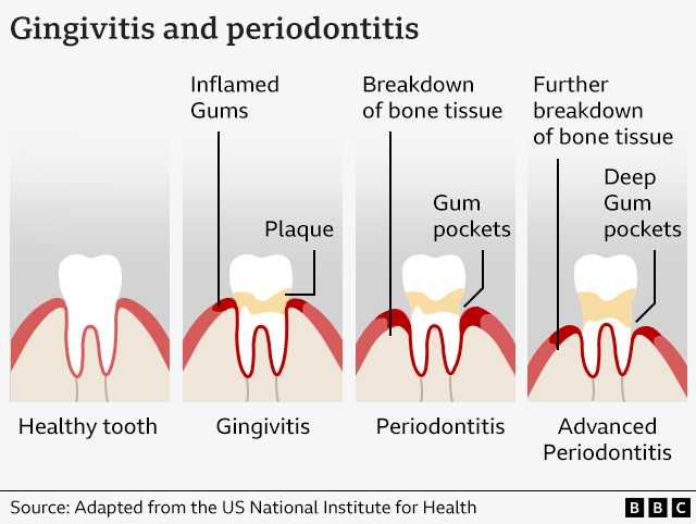 A graphic showing how gum disease develops in health teeth