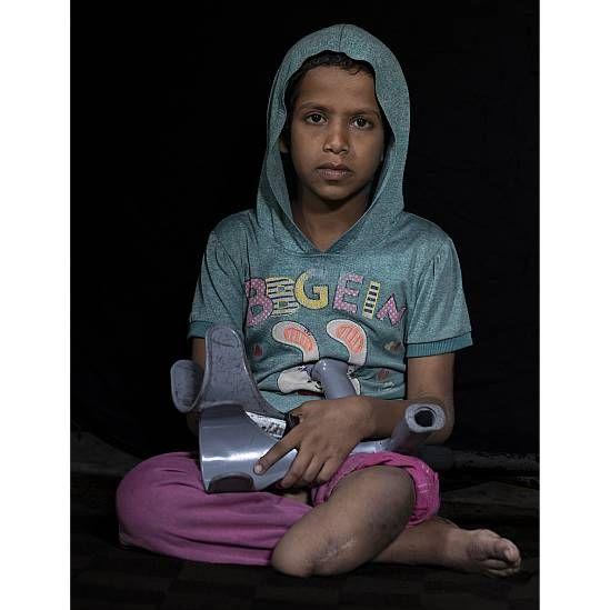 Un niña de 10 años sentada. Su pierda izquierda fue amputada tras un ataque israelí. 