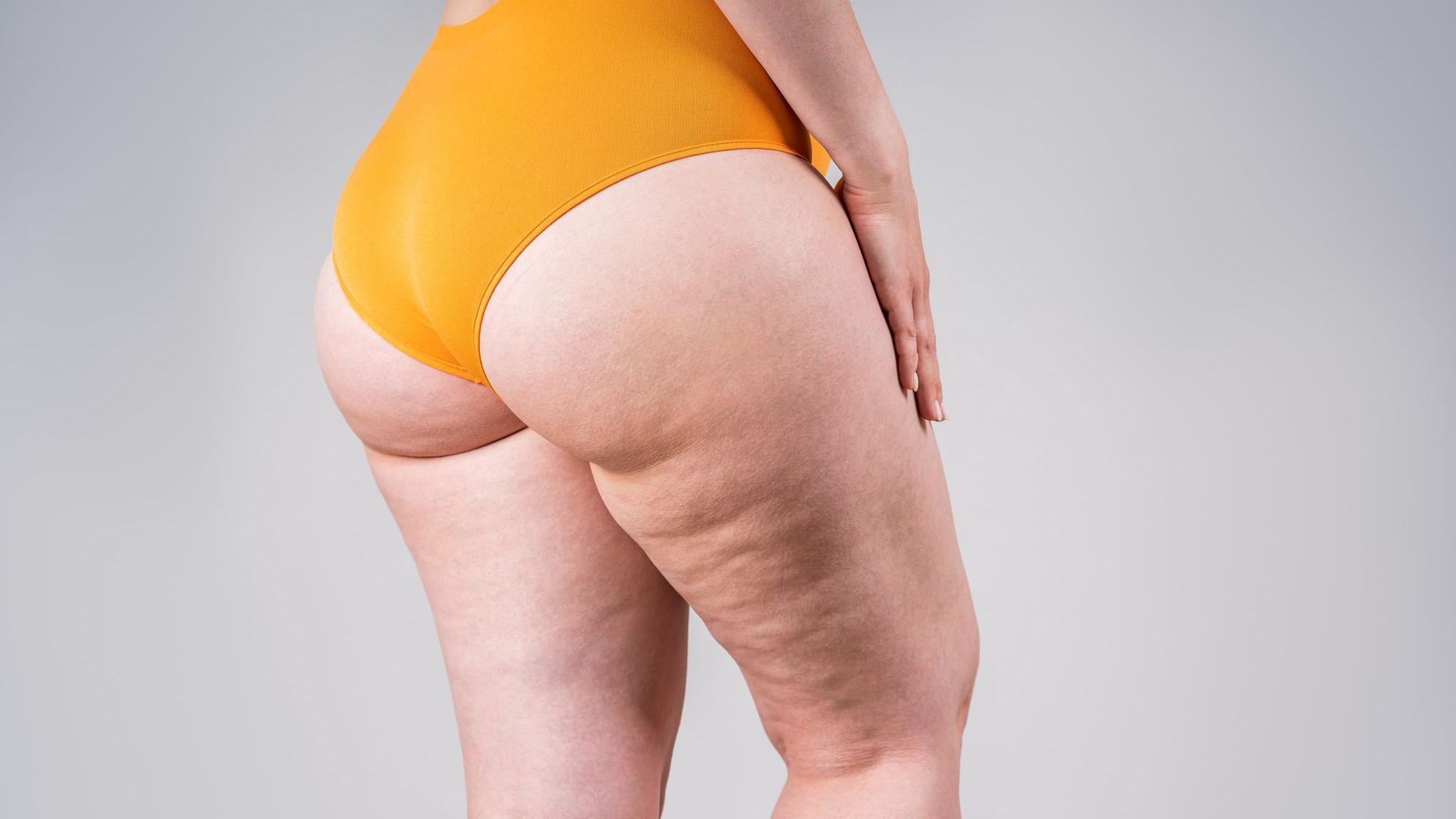 Žena u donjem vešu sa celulitom na nogama