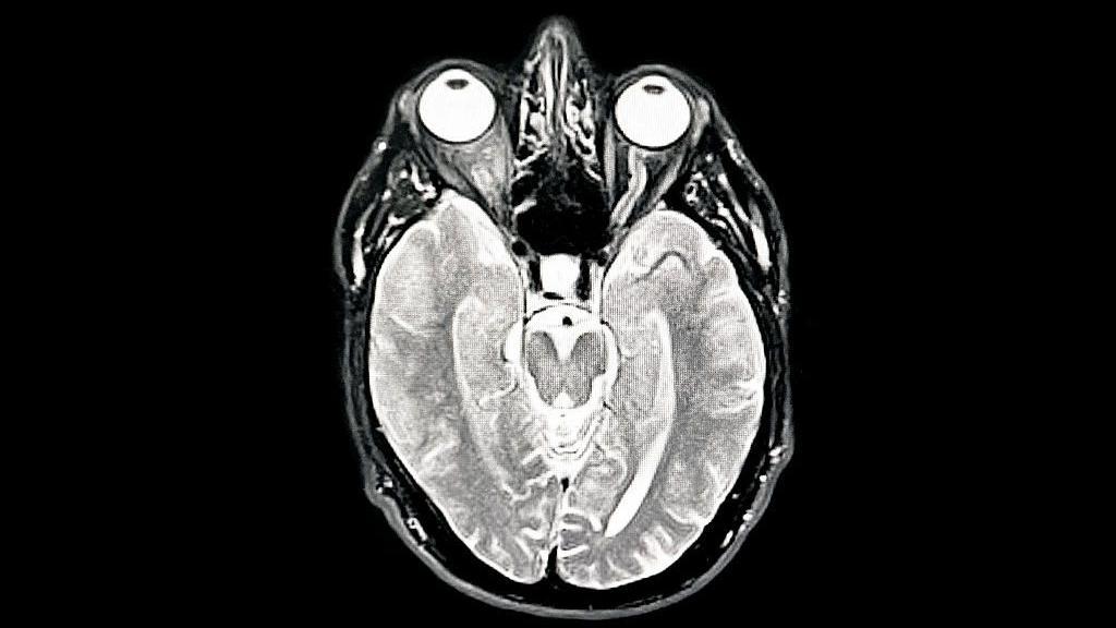 Una tomografía MIR del cerebro del fotógrafo muestra demencia temprana/Alzheimer