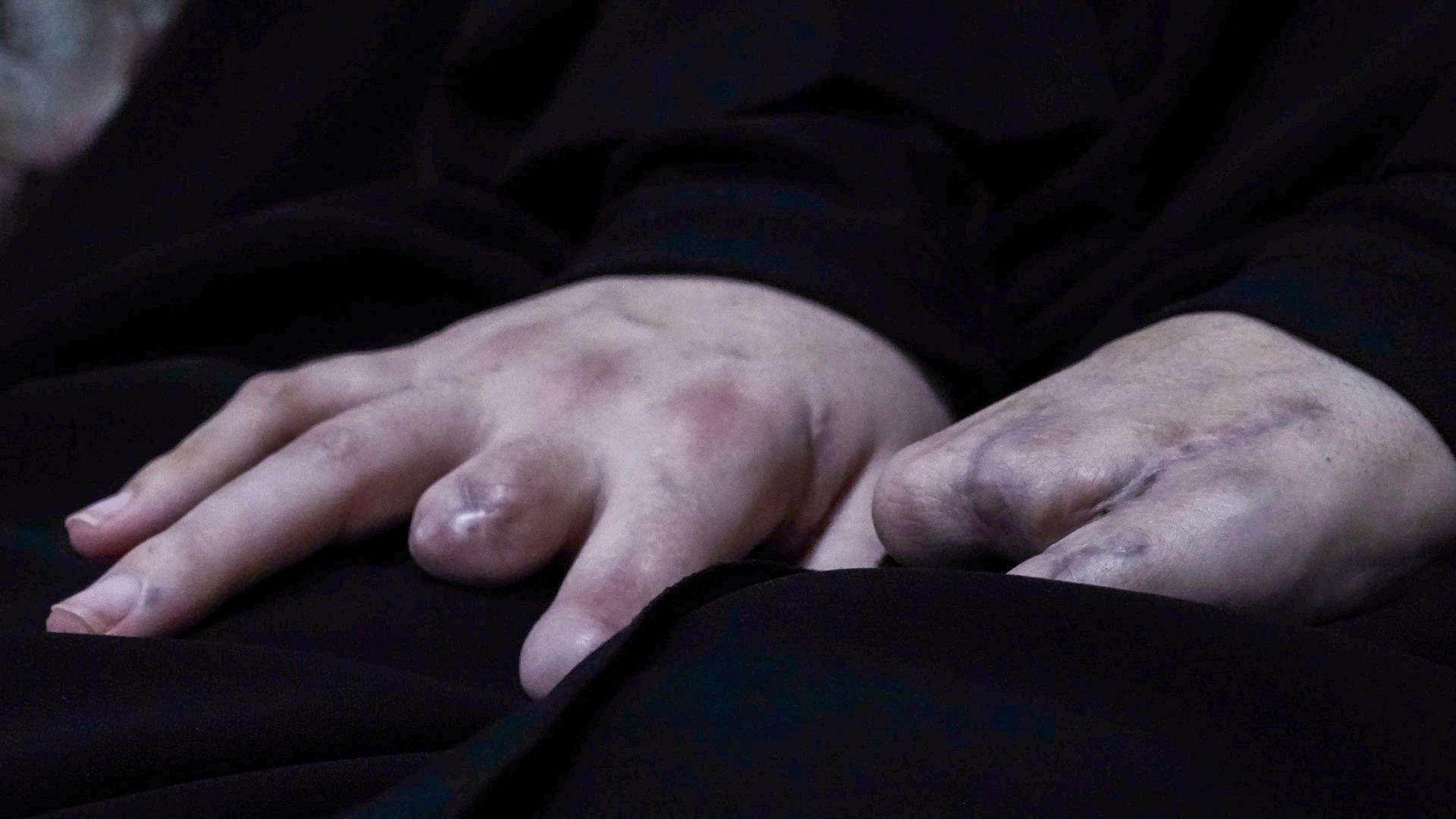 يدا نايفة تستقران على حجرها، إحداهما بها إصبعان مفقودان تقريباً بالكامل، بينما يبدو أن الأخرى لم يتبق منها أي أصابع.