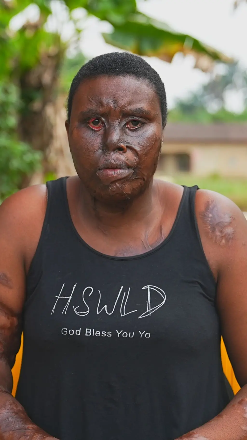 An acid attack survivor
