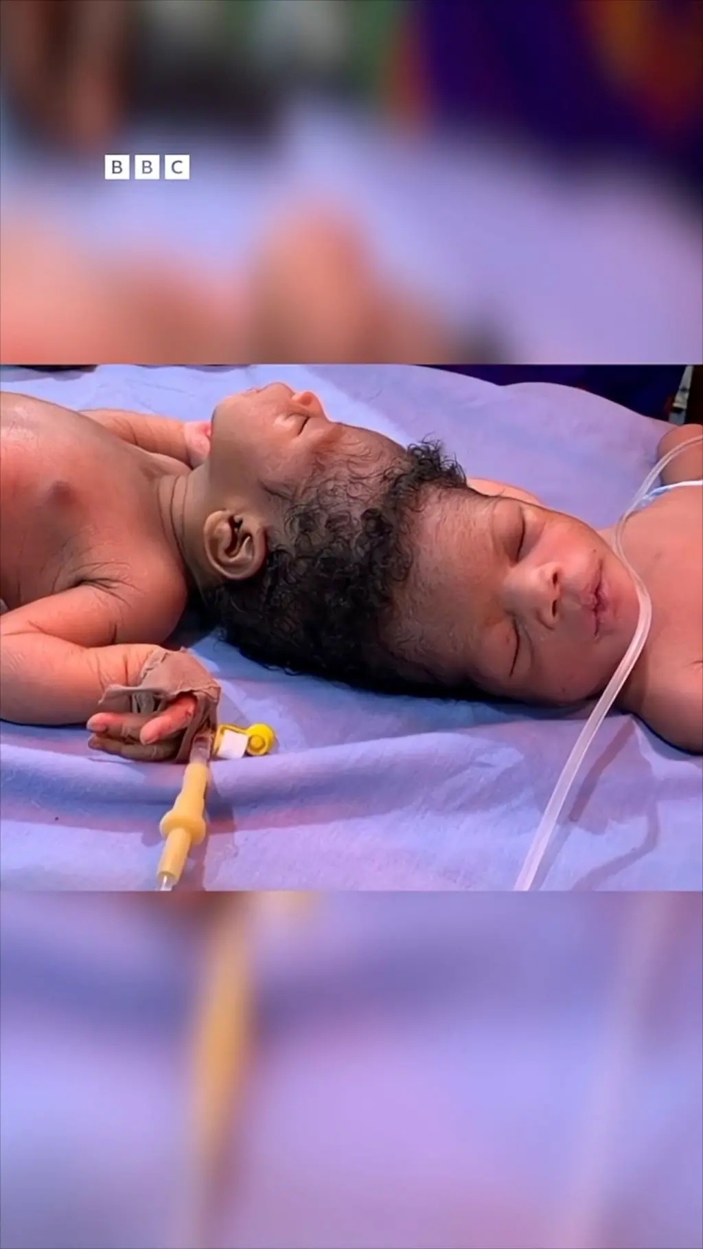 Sida AI u caawiyay mataanahaan dhashay iyagoo isku dheggan