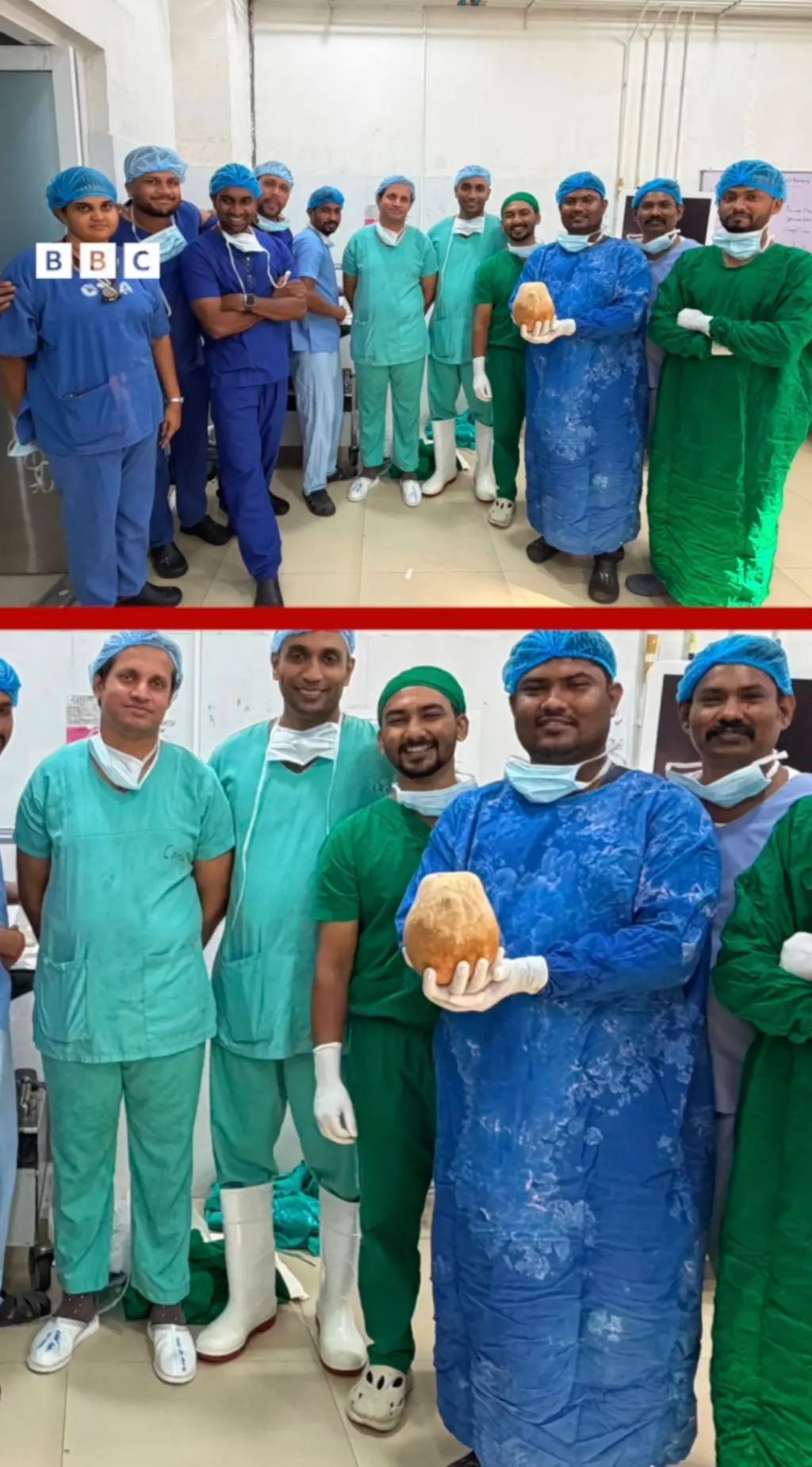 පුද්ගලයෙකුගේ මුත්රාශයෙන් 3.1kg විශාල ගලක් හමුවේ