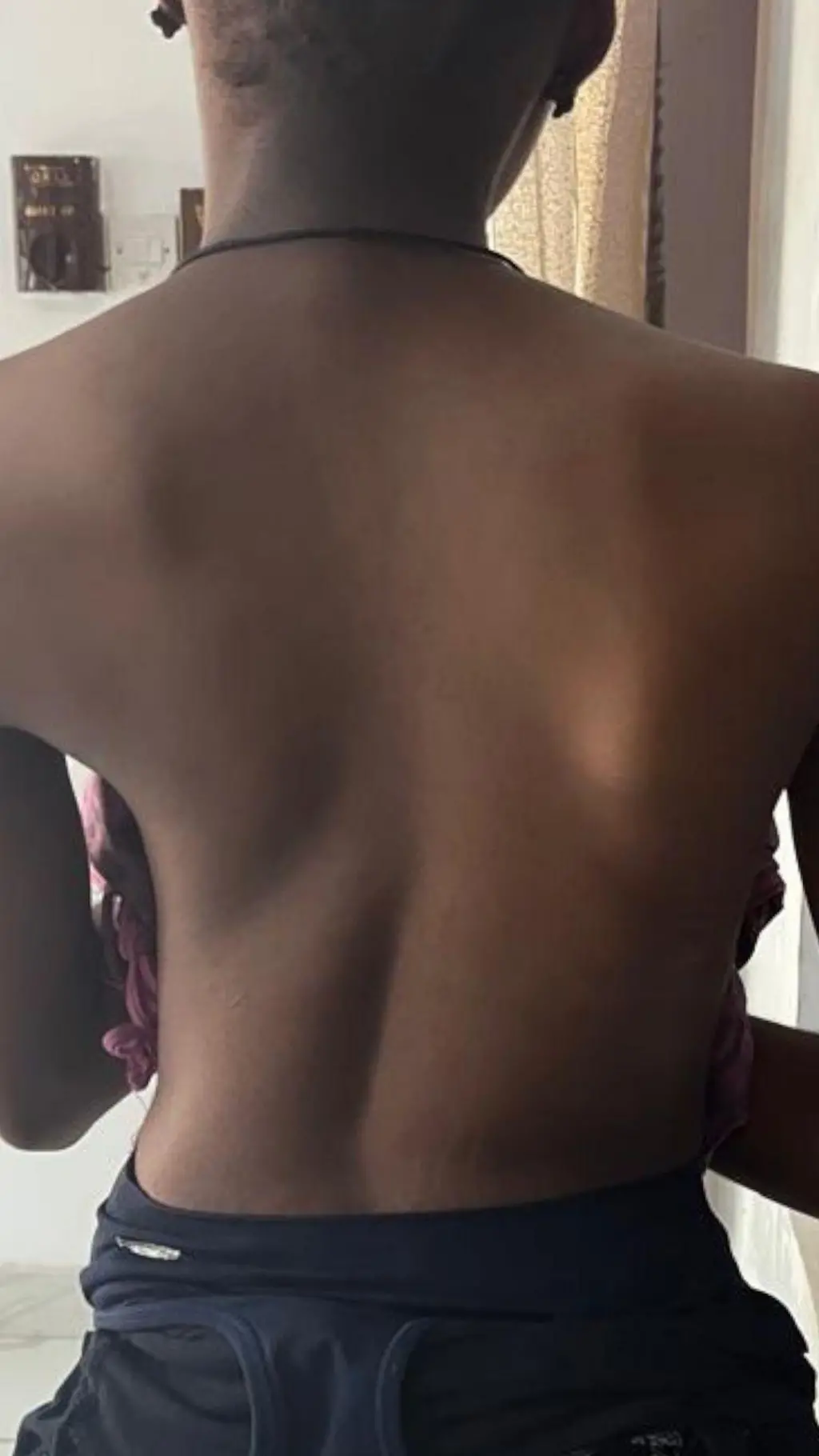 Foto nwatakịrị nwere Scoliosis