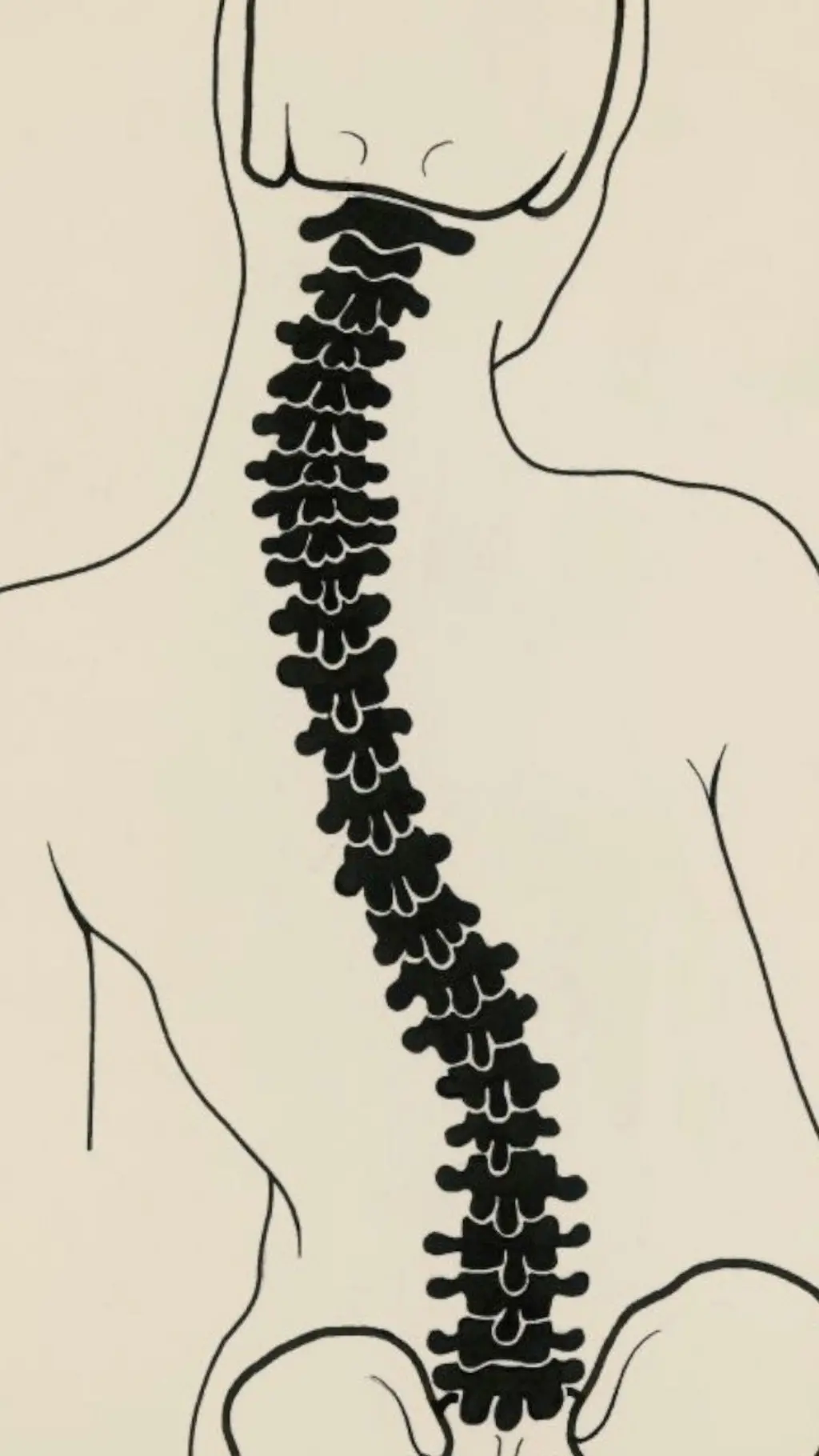 'Scoliosis' bụ ọnọdụ ahụike nke ọkpụkpụ azụ mmadụ bụ 'spine' n'asụsụ Bekee na-agbagọ agbagọ gaa n'otu akụkụ ahụ onye ahụ.