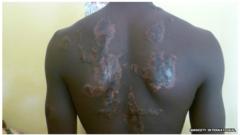 Cet adolescent était soupçonné d’appartenir au groupe de combattants islamistes Boko Haram. On lui a versé du plastique fondu sur le dos en 2013.