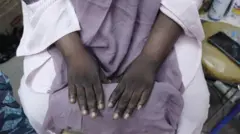 Bleached hands, showing a contrast between the darker knuckles and areas of paler skin