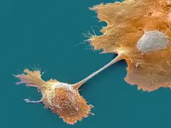 Células de câncer de pâncreas
