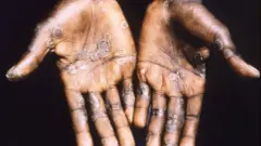 Xanuunka furuqa daanyeerka