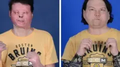 transplatacija lica