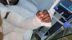 Ukuboko kw'umusore kwacitse kugasubizwaho n'abaganga b'inzobere