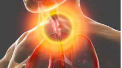 የጉሮሮ ካንሰር