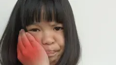 Seorang anak perempuan menaruh tangan di pipinya menahan sakit gondongan.