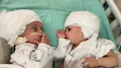 Sijamske bliznakinje