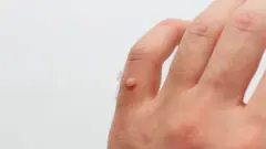 పులిపిర్లు