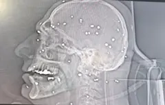 تصویر رادیولوژی صورت فردی که مورد اصابت ساچمه قرار گرفته است.