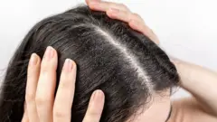 শীতে চুলে খুশকি হয় কেন, দূর করার উপায় কী?