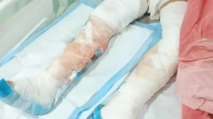 மனித சதையை உண்ணும் பாக்டீரியாவால் சிறுவன் காலை இழந்தானா?