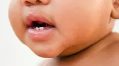 L'agglutination de la langue est une maladie génétique qui retient de plus en plus l'attention des médecins et des familles du monde entier