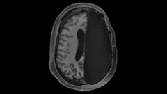 ภาพสแกน MRI ของสมองที่เหลือเพียงครึ่งซีก