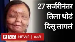 अ‍ॅसिड हल्ला