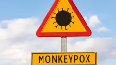ਮੰਕੀਪੌਕਸ