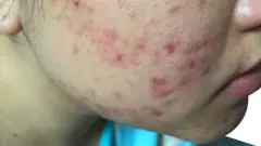 آکنه