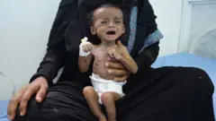 نزدیک به دو میلیون کودک یمنی دچار سو تغذیه هستند