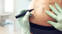 প্লাস্টিক সার্জারির জন্য শরীরে চিহ্ণ দেয়া হচ্ছে