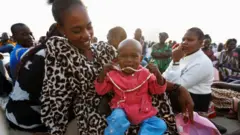 Umwana ufite ishapule akikiwe na nyina 