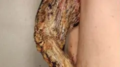 ከካንሰር ታማሚ ላይ የተወገደው ቀንድ