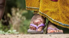 Onye nwere ọrịa Lymphatic