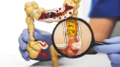 Un modelo del intestino grueso resaltando un divertículo en el sigmoideo