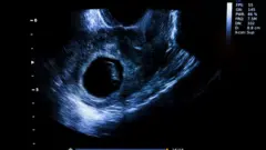 early pregnancy