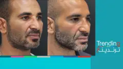 صور الفنان أحمد سعد قبل وبعد عملية التجميل التي خضع لها