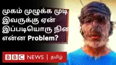 ஓநாய்-மனித நோய்