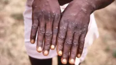 آبله میمونی همراه با علایم پوستی است