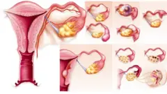Ovarian cyst