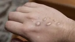 Monkeypox rash