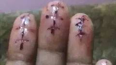 விரல்களில் அறுவை சிகிச்சை