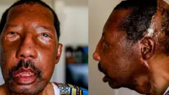 Transplantacija lica