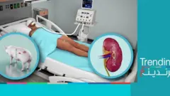 لأول مرة.. نجاح زراعة كلية خنزير في جسم إنسان