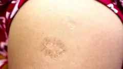 لقاح بي سي جي