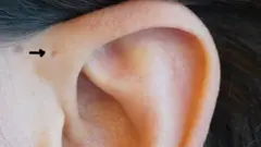 Hoyuelo o fosita preauricular en la oreja
